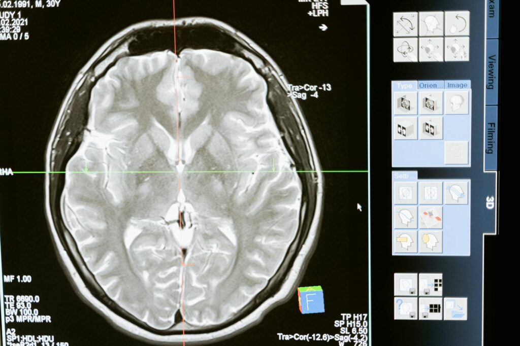 brain scan aggression